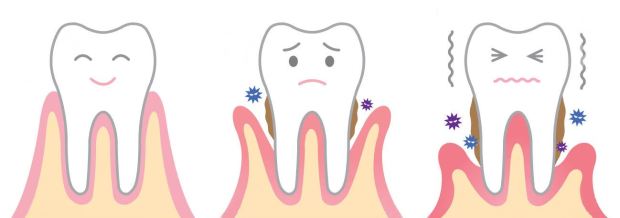 37209409-malattia-parodontale-Archivio-Fotografico