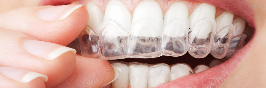 Invisalign_Angeri-900x300